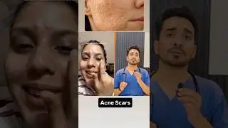 Acne Marks vs Acne Scars
