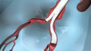 LP animation NO disclaimer