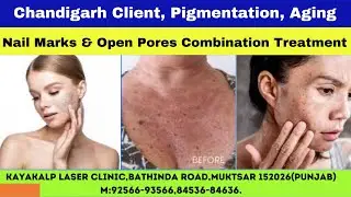 Chandigarh Client, Pigmentation, Aging, Nail Marks & Open Pores Combination Treatment