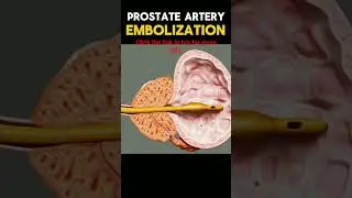 #prostatehealth #prostatecancertreatment #prostatehealth #prostatesupport