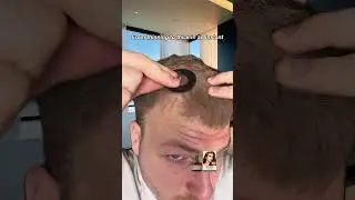 Bald spots? Receding hairline?!#HairFiber #HairlinePowder #OEMHairCare #BeautySupply