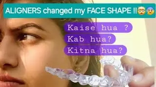My FACE changed because of ALIGNERS 😐| #aligners #teeth #braces #dentalcare #smile #indore #skincare