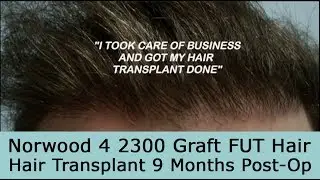 9 Month Post-Op 2300 Graft FUT Hair Transplant on Norwood 4 Pattern