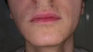 Lumenis Lightsheer Duet - male facial hair removal - 1 year after