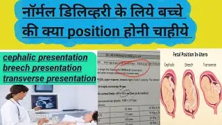 Cephalic presentation   क्या नॉर्मल बेबी डिलिव्हरी के पोसिशन चाहीये#baby position#normaldelivary