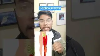 साईटिका, फिजियोथैरेपी इलाज | Sciatica ka Physiotherapy Treatment | Pain se Recovery Tak #sciatica
