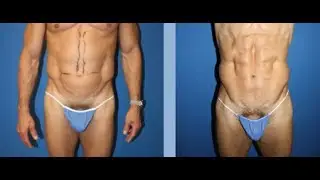 Dr. Steinbrech discusses male plastic surgery in NYC