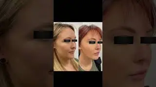 Quantum RF Before & After Gallery | Non-Surgical Face & Body Contouring