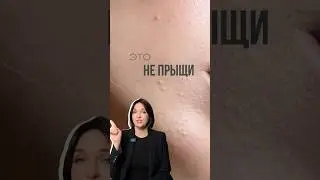 Как убрать милиумы #уходзакожей #акне #косметолог #уходзажирнойкожей