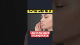 Acne Treatment Tips #skincare #acnesolutions