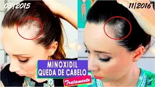 MINOXIDIL: 2 ANOS DE TRATAMENTO por Virgínia Gaya