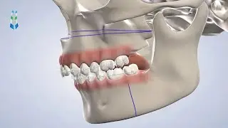 Orthognathic Surgery in Springfield IL at Oral & Facial Surgeons of Illinois
