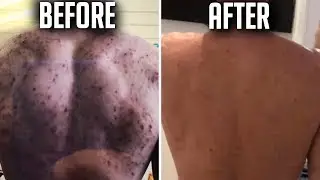 How To Get Rid of Body Acne