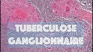 LA LYMPHADENITE TUBERCULEUSE - PATHOLOGIE