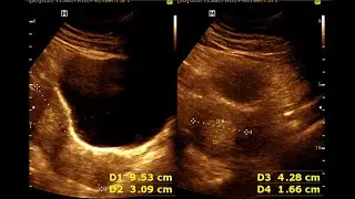 Retained product of conception within the endometrium || Miscarriage || Normal Pregnancy