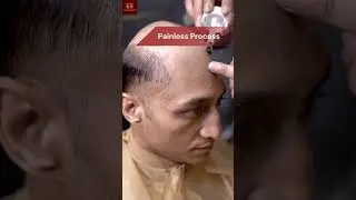 Instant Hair Transformation without Surgery 🤯🔥