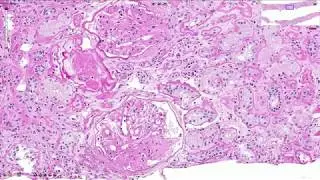 Diabetic Nephropathy - Histopathology