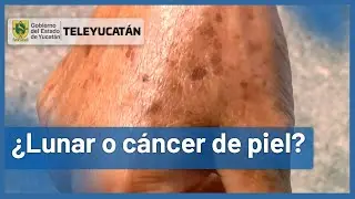 🤔&iquest;C&oacute;mo saber si es un lunar o c&aacute;ncer de piel? | AQU&Iacute; TE LO DECIMOS ✅| TELE Yucat&aacute;n