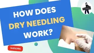 What is Dry Needling? [Evidence-Based]