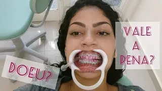 Clareamento dental de consultório