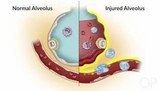 Fluid Management in Acute Respiratory Distress Syndrome by S. Valentine | OPENPediatrics