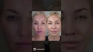 VI Peel | Dr. Paul Nassif