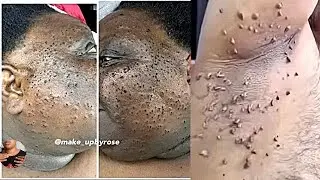 OVERNIGHT remove skin using strong remedy for skin tags
