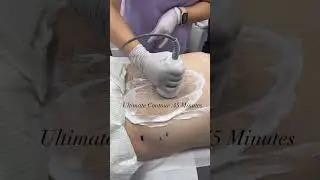 Ultimate contour #bodycontour #bodysculpting #medspa