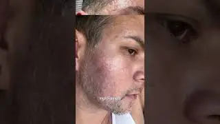 Is There Any Hope for Improving Rolling Acne Scars?