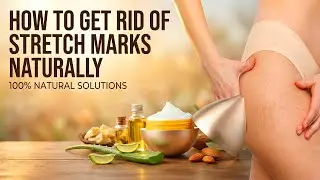How to Get Rid of Stretch Marks Naturally at Home | Tips to Reduce Stretch Marks | Skin Care Tips