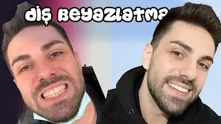 DİŞLERİMİ BEYAZLATTIM | Sigara İçenler Kesin İzlesin.
