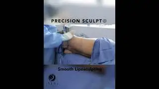 AWAKE BUTT LIFT&reg;️ | PRECISION SCULPT&reg;️ | LIPO 360 | LONG TERM RESULTS | HIP DIPS FILLED | AWAKE BBL