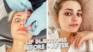 i got lip injections!!!! experience + husband's reaction...