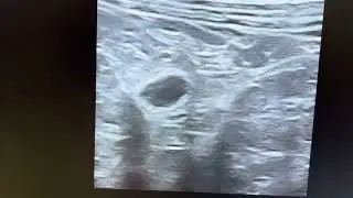 Typical picture of perforated appendix got resolved by itself. Base dilated. Rest length thick