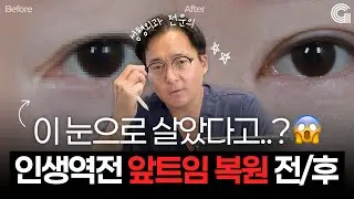 앞트임 흉터 때문에 눈 망친 사람들… 복원으로 달라진 모습