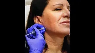 Jawline Dermal Fillers Colorado Springs   MD Boutiqes Med Spa