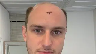 Preparing for a Hair Transplant