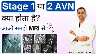 Stage 1 या 2 AVN क्या होता है? आओ समझे MRI से | AVN Hip Stage 1 & 2 Treatment Explained