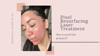 Pixel Resurfacing Laser Treatment | Was it worth the process?!
