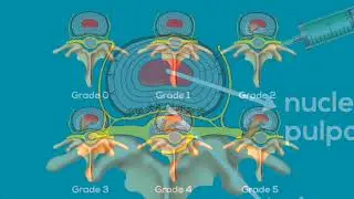 The Relevance of X-Rays and MRI in Diagnosing Internal Disc Disruption (3 Minutes)