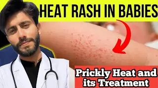 INSTANT RELIEF FROM HEAT RASH ( Maliaria ) | GARMI KI DONON KA ASAAAN ILAJ