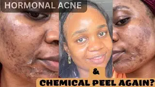Chemical peel treatment for hormonal acne | What chemical peel did to me | procedure & skin routine