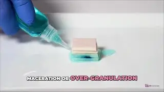 When exudate exceeds expectations, moisture imbalance can quickly compromise the wound environme...
