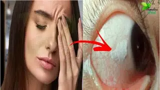 Home Remedies To Get Rid Of Bitot Spots | Bitot Spots Removed