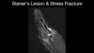 Stener's Lesion & Stress Fracture
