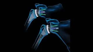 Total Shoulder Arthroplasty
