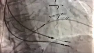 30 years of pacemaker technology represented by a single patient