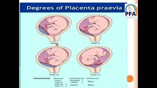 Bleeding late in Pregnancy مادة تمريض النسا- شعبة التمريض العام- الفرقة الثانية2021- د. رحاب فتحي