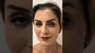 WOW - ce rezultat frumos &icirc;nainte și după Blefaroplastie inferioară la Clinica Dr. Levy București