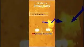 Hard Exudates | Diabetic retinopathy | Fundus Photography | Short Video 448